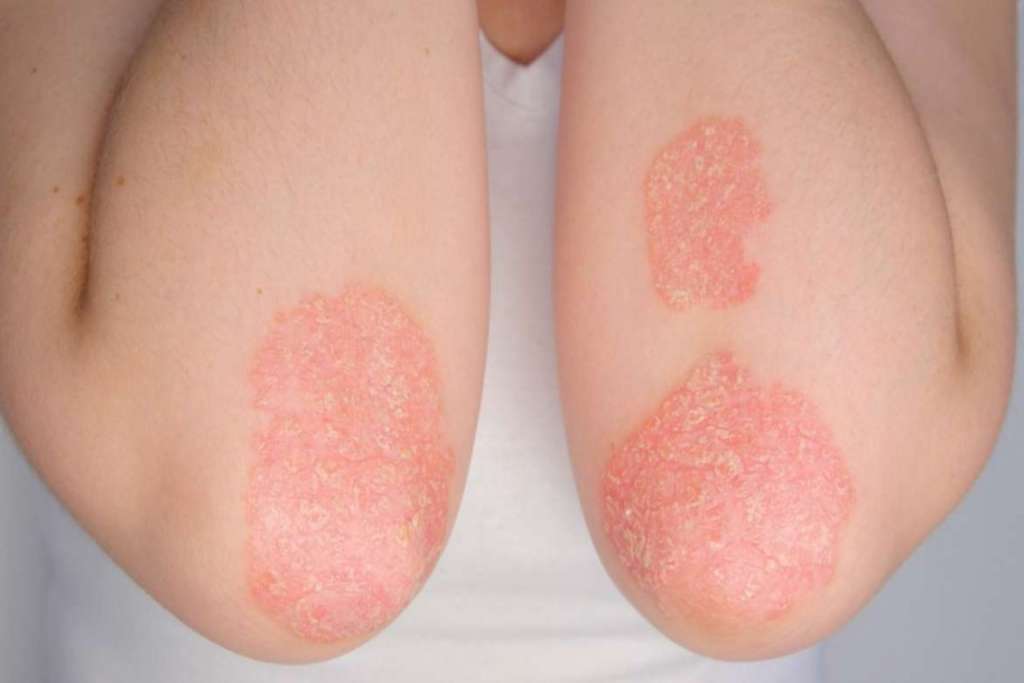 Know psoriasis and how to treat it